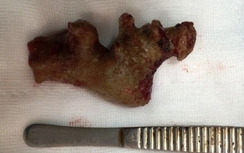 Phẫu thuật thành công lấy sỏi thận khủng