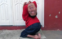 Cảm động sức sống mãnh liệt của người đàn ông có đầu lộn ngược