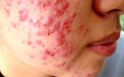 Rước họa vì dùng mỹ phẩm xách tay