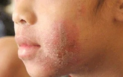 Gia tăng bệnh nhi bị kiến ba khoang đốt