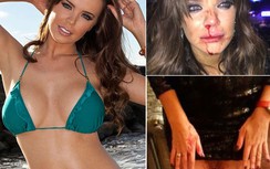 Đi chơi đêm, siêu mẫu Anh bị đánh chảy máu mũi