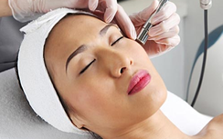 Xóa nám bằng laser có an toàn?