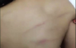 Học sinh lớp 1 bị cô giáo đánh tím lưng vì... nghịch cục tẩy