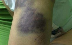 Hải Phòng: Con gái tố bị bố đẻ đánh nhập viện