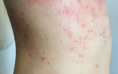 Đà Nẵng: Khách tắm biển bị ngứa là do sứa?