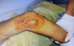 Bắt thêm đối tượng chém trọng thương một Việt Kiều