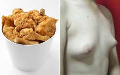Ngực chàng trai phát triển như phụ nữ vì ăn nhiều gà rán