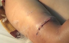 Nối thành công cánh tay gần bị đứt lìa của một cán bộ xã