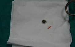 Một phụ nữ bị bắn thủng hàm trên đường đi làm về