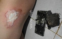 Điện thoại Xiaomi Trung Quốc phát nổ, người dùng Việt bỏng đùi