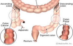Bệnh polyp trực tràng là gì, có nguy hiểm không?