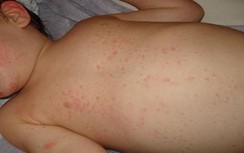Hà Nội: Một trường hợp tử vong vì bệnh sởi