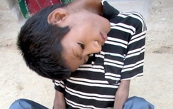 Kỳ lạ cậu bé có cổ vẹo 180 độ