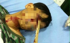 Ngã xe máy, bị cọc nhọn dài 60cm đâm thẳng vào mắt