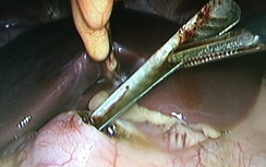 Uống nước chanh, nuốt luôn thìa vào bụng