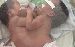 Sức khỏe của đôi trẻ song sinh dính liền chuyển biến xấu