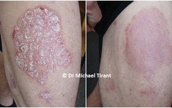 Điều trị vảy nến bằng thảo dược