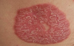 Bệnh vẩy nến và đồ uống có cồn