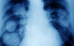 Đã tìm ra cách ngăn chặn ung thư di căn