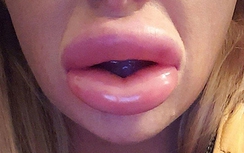 Thẩm mỹ giá rẻ, cô gái Anh môi sưng to như xúc xích