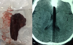 Bình Thuận: Cứu sống người đàn ông bị dao cưa cấm vào trán