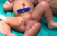 Bé gái chào đời với 3 chân ở Ấn Độ