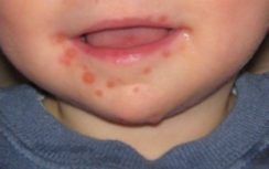 Những bệnh hay tấn công trẻ em vào mùa hè