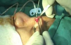 Đi làm đẹp, cô gái bị bác sĩ bỏ quên gạc trong mũi