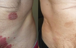 Điều trị bệnh vẩy nến hiệu quả và an toàn bằng thảo dược