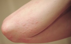 Cách chữa trị bệnh nổi mề đay, dị ứng