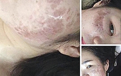 “Tiền mất, tật mang” vì lăn kim làm đẹp da mặt