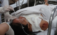 Một phụ nữ bất ngờ bị người chồng hơn 22 tuổi tạt axit