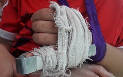 Phụ huynh tố cô giáo mầm non đánh gãy ngón tay trẻ