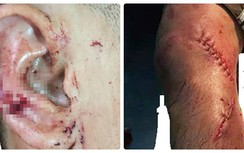 TP.HCM: Giận chồng nhậu say, vợ cầm dao chém đứt tai và gân chân