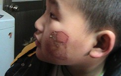 TP.HCM: Cháu bé 3 tuổi nghi bị cô giáo đánh bầm mắt