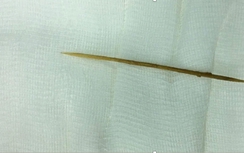 Cứu sống người nuốt phải tăm tre đâm thủng ruột non