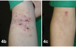 Trị dứt điểm viêm da cơ địa trẻ em bằng thảo dược