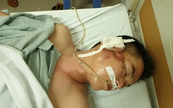 Sức khỏe tài xế bị MazdaCX5 chèn qua người, bắn thủng bụng ra sao?