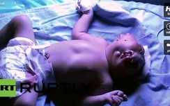 Xót thương em bé có 2 mặt trên đầu