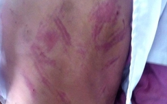 Bé 7 tuổi bị mẹ kế đánh dã man vì đánh mất 1.000 đồng