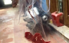 Quên gạc trong chân bệnh nhân, bác sĩ bị đình chỉ