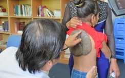 Chuẩn bị phẫu thuật cho bé gái mang căn bệnh "mai rùa" kì dị