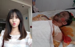 Cô gái bị bỏng toàn thân do TNGT đã tử vong