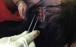 Mâu thuẫn với bạn, một thiếu nữ bị đánh trọng thương