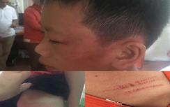 Nghi vấn nữ giáo viên bạo hành con riêng của chồng đến nhập viện