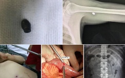 Nổ súng khi hỗn chiến: Người thủng bụng, kẻ bị đạn bắn thấu vai