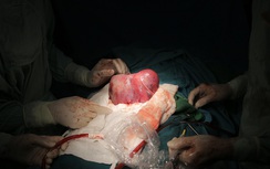 Kỳ diệu bé trai chào đời cùng khối u xơ khổng lồ