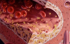 Bị rối loạn mỡ máu, nên ăn gì trong dịp Tết?