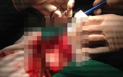 Chớ chủ quan với hạch vùng cổ