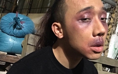 Trấn Thành "bị đánh bầm dập" sau scandal tình cảm với Hari Won